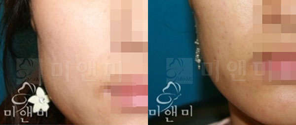 [시술전후사진]턱보톡스 시술전후