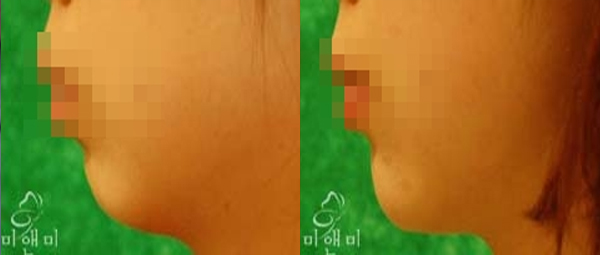 [시술전후사진]무턱필러시술전후사진